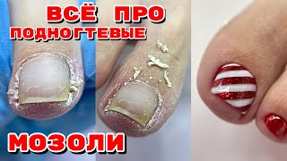 ВСЕ про ПОДНОГТЕВЫЕ МОЗОЛИ 🦶 Педикюр 🦶 Дизайн ногтей на ногах