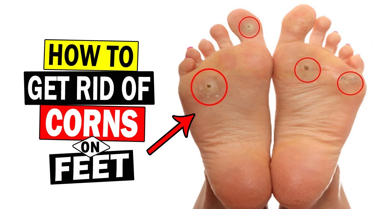 How to Get Rid of Corns on Feet Fast || Home Remedies for Foot Corn ...