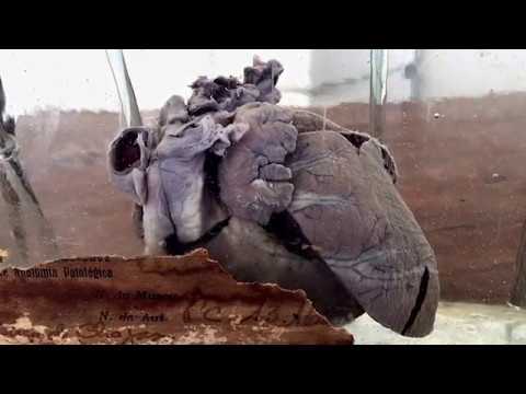 Miniatura do vídeo: Coração (Chagas)