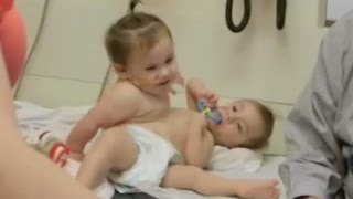 Conjoined Twins Successfully Separated