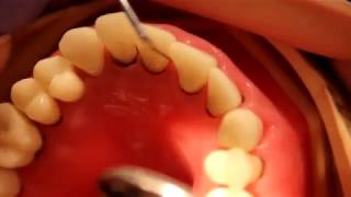 Gingival index - REU Students