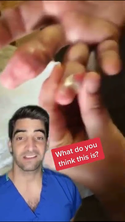 Gout in the finger