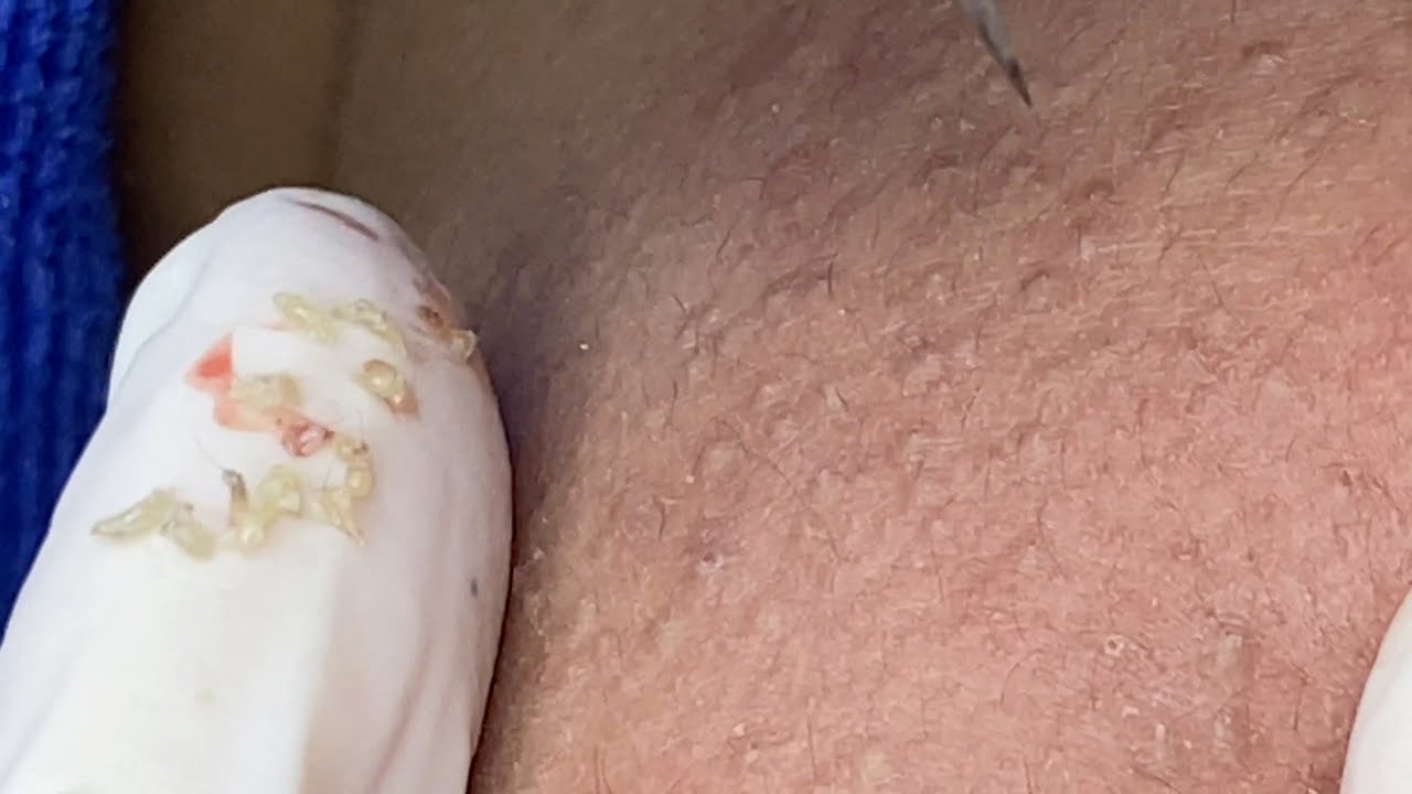 Acne Under The Skin | Mụn Ẩn - SacDepSpa#297