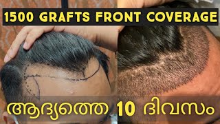 Hair O Dent in KadavantharaErnakulam  Best Hair Transplant Clinics in  Ernakulam  Justdial