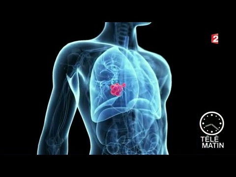Vidéo: Les Meilleurs Blogs Sur Le Cancer Du Poumon De