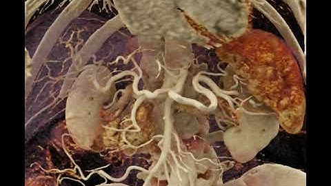 Cinematic Rendering (CR)