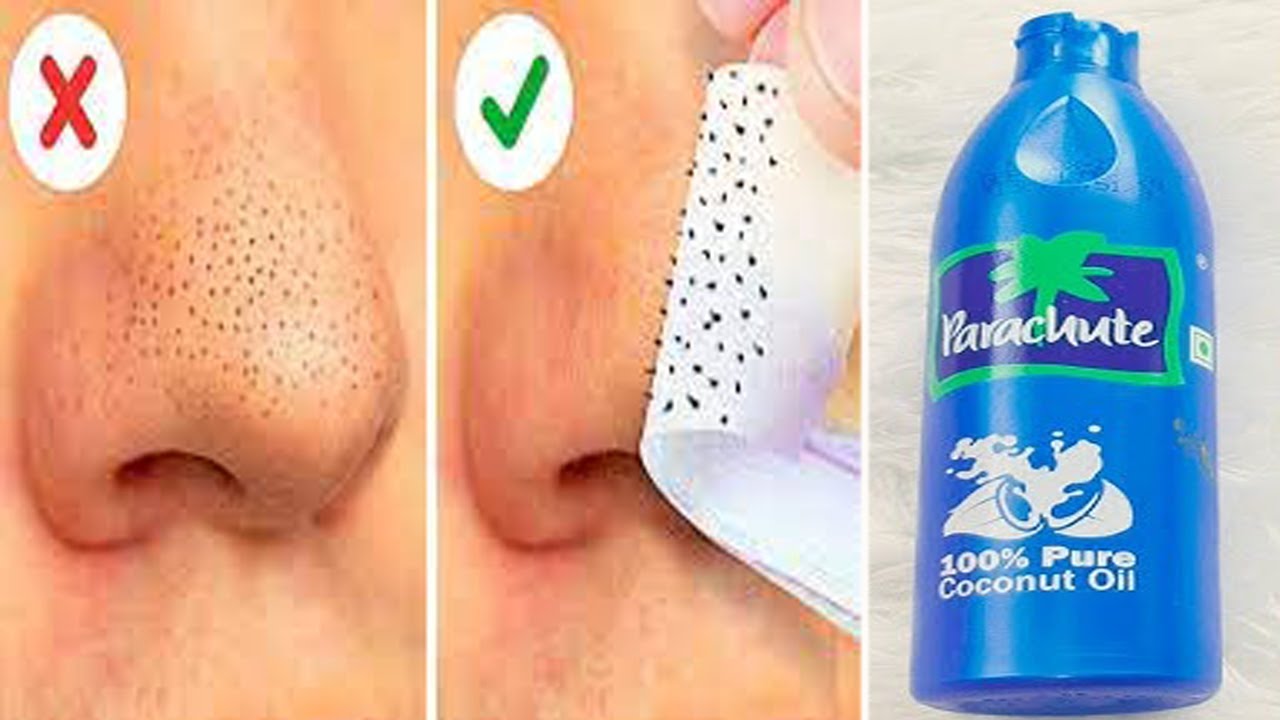 How to Remove Blackheads and Whiteheads On Nose Naturally At Home with ...