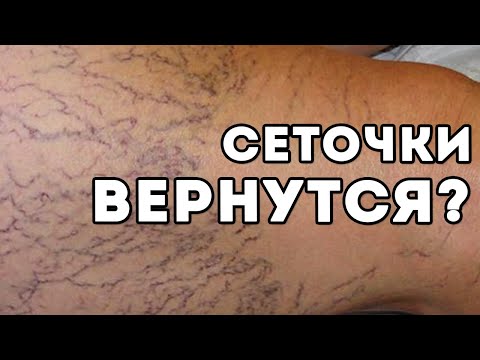 СКЛЕРОТЕРАПИЯ бесполезна? РЕЦИДИВ