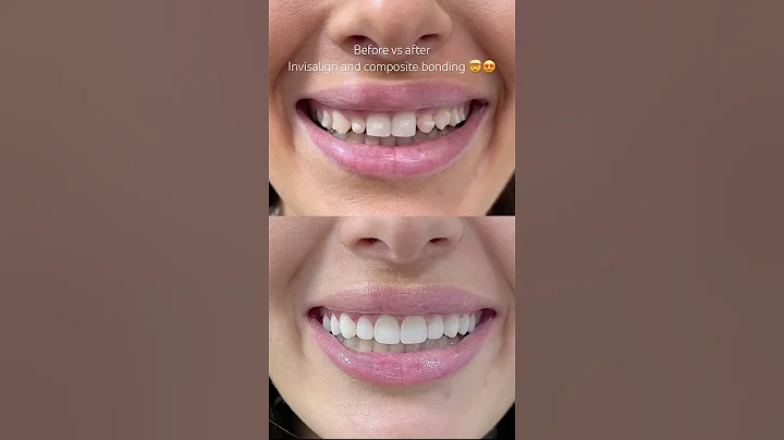 Invisalign and composite bonding by Dr. Sonnie 🙌 #compositebonding