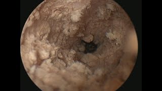 Walters Right Ear Cleaning