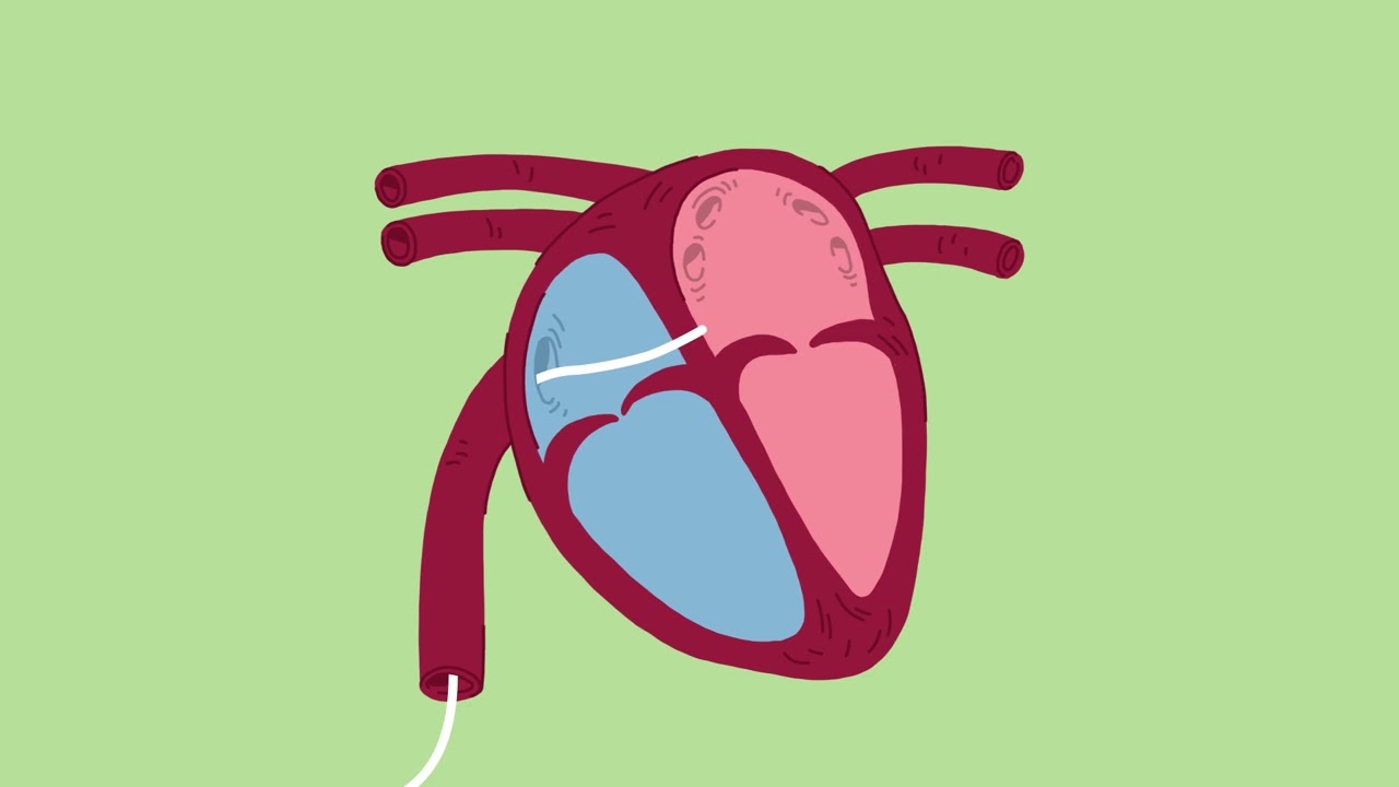 Ablation de la fibrillation auriculaire au Centre de cardiologie de l'Hôpital universitaire de Bâle