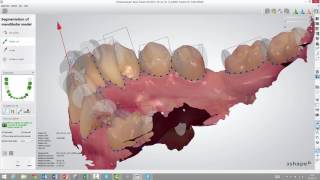 3Shape Ortho Analyzer - How to Segment Teeth