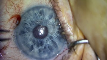 Removal of Nuclear Fragment