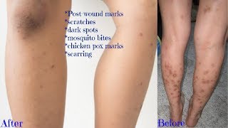 Updated How To Get Rid Of Dark Spots On Legs Body Fast Get Clear Even Skin Tone Youtube