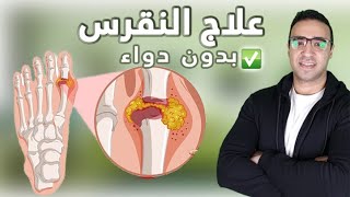 علاج النقرس النهائي بدون ادوية وكيفية الحماية من أعراضه - Gout