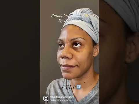 Video thumbnail: Closed Rhinoplasty @AlbertPlasticSurgery — Albert Plastic Surgery New York