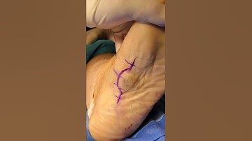 Excision of a plantar fibromatosis.