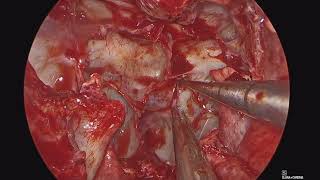 Endoscopic Endonasal Approach for Craniopharyngioma Resection with Nasoseptal Flap Reconstruction
