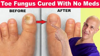 Toe Nail Fungus Cured With No Meds!  Dr. Mandell