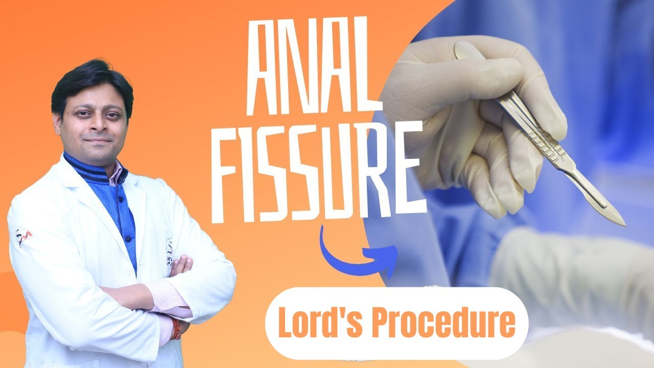 Anal Fissure Lord s Procedure By Dr Vikas Gupta YouTube Anal Fissure Lord s Procedure By Dr Vikas Gupta YouTube