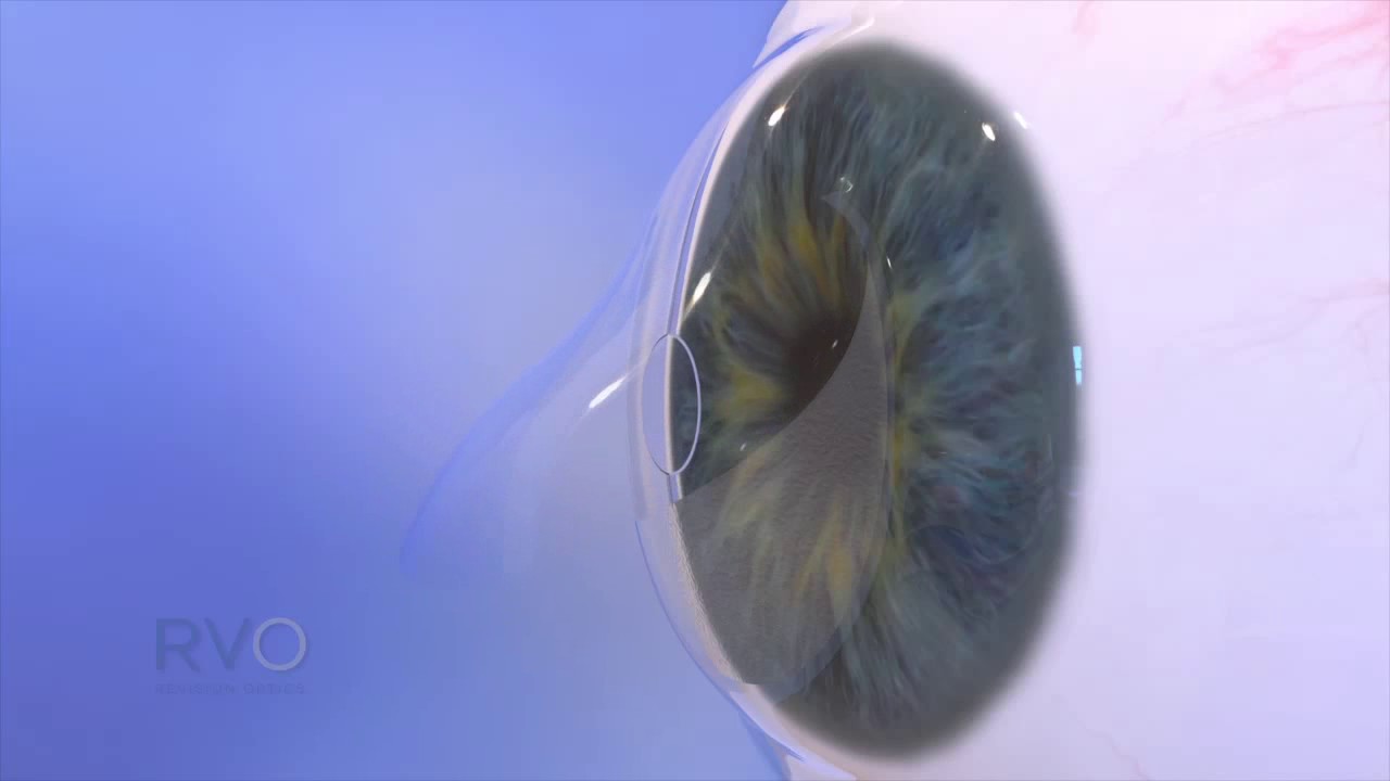 raindrop eye surgery reviews raindrop eye surgery reviews