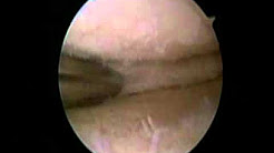 Knee arthroscopy meniscus tear with arthritis