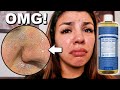 I Used Dr. Bronner's Castile Soap On My Face!