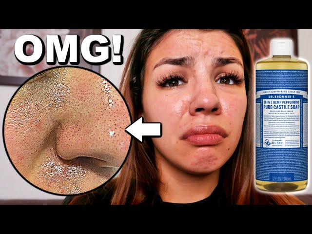 I Used Dr. Bronner'S Castile Soap On My Face! - Youtube