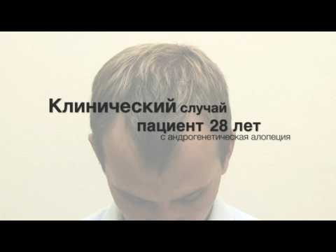 Видео: Алопеция - причини и симптоми на алопеция