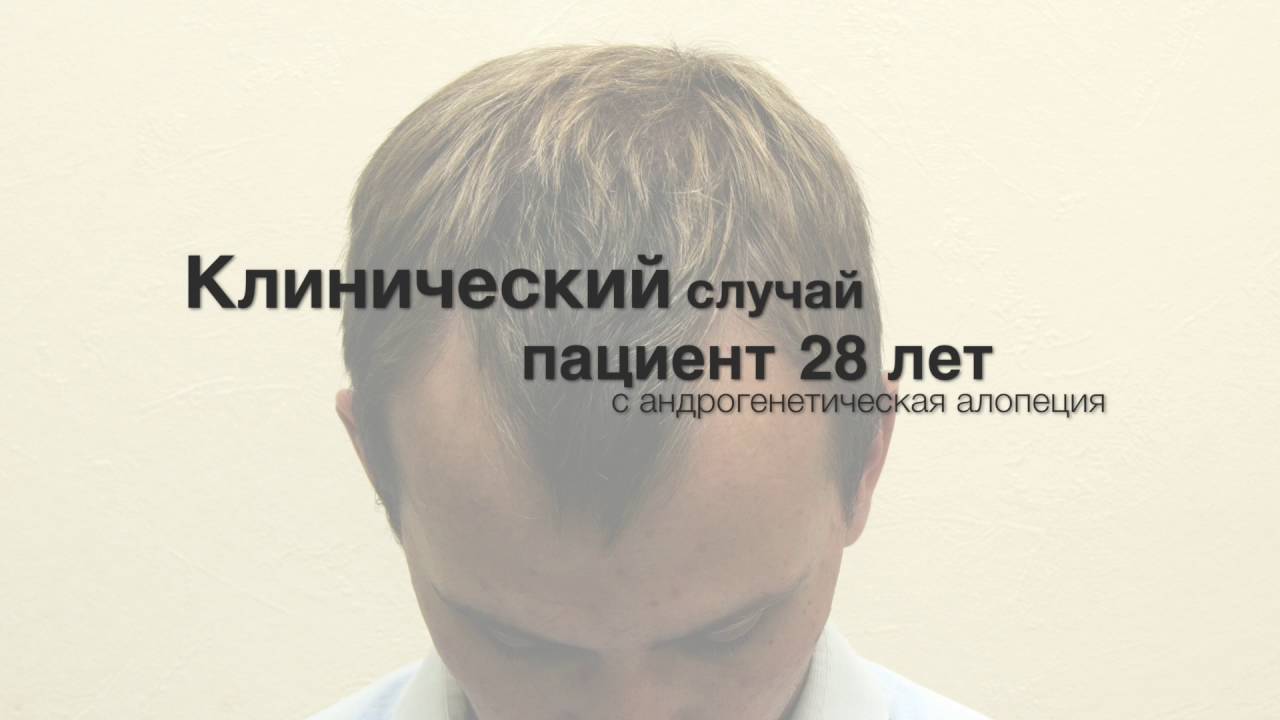 Смотреть Методы лечения андрогенной алопеции видео Смотреть Методы лечения андрогенной алопеции видео