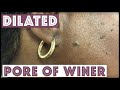 Two small Dilated Pore of Winers on the face