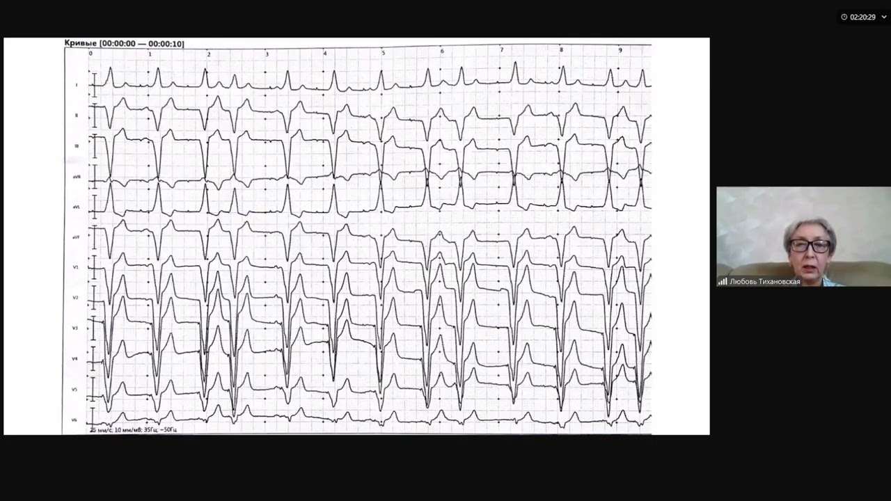 Основные подходы к интерпретации ЭКГ у пациентов с ЭКС при холтеровском мониторировании