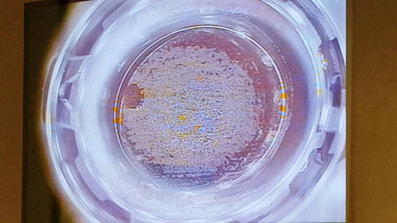 Lasik at Millennium Laser Eye Center YouTube