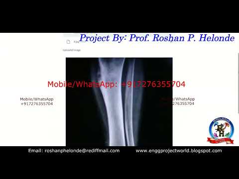 Bone Fracture Detection Using Image Processing With Source Code | Python Project Fracture Detection