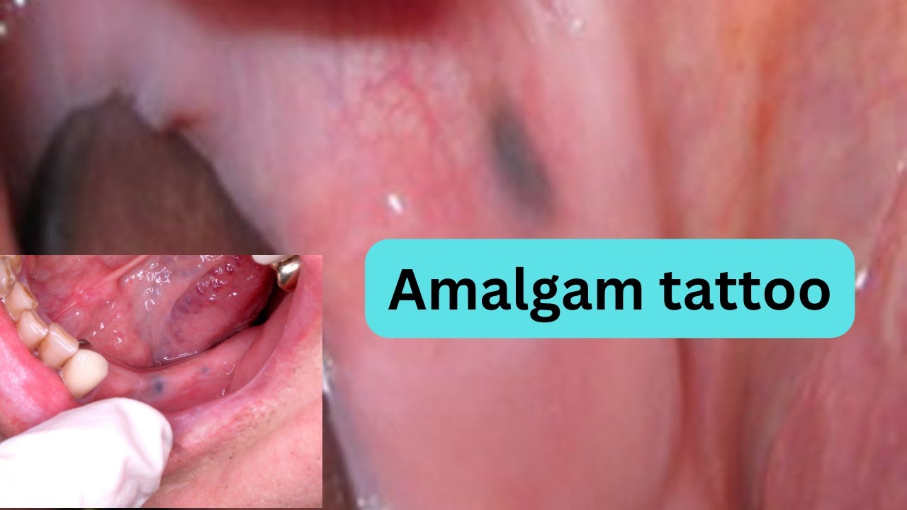 Amalgam Tattoo Mimicking Mucosal Melanoma A Diagnostic Dilemma Revisited