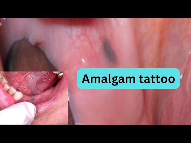 Amalgam Tattoo – Exodontia