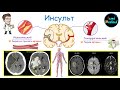 Инсульт Головного Мозга | Виды | Анатомия | Физиология | Патогенез | Клиника | Диагностика | Лечение