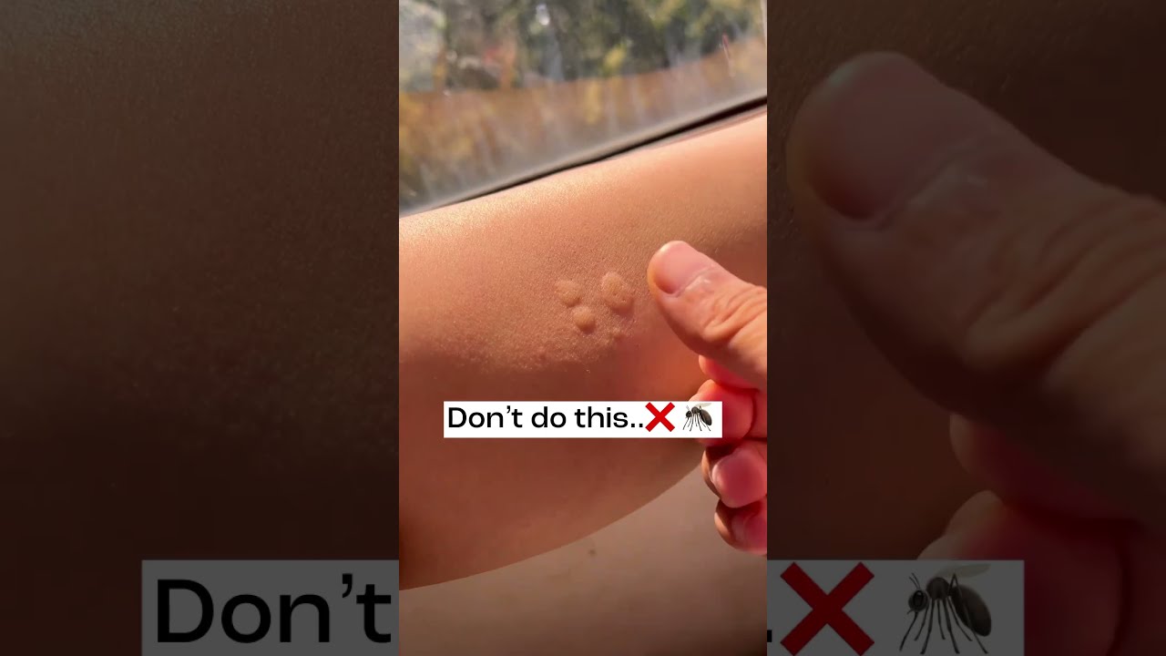 Mosquito Bite 5 Minutes Solution No More Itchiness Or Black Spots
