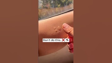 Mosquito bite 5 minutes solution 😍 🦟  no more itchiness or black spots