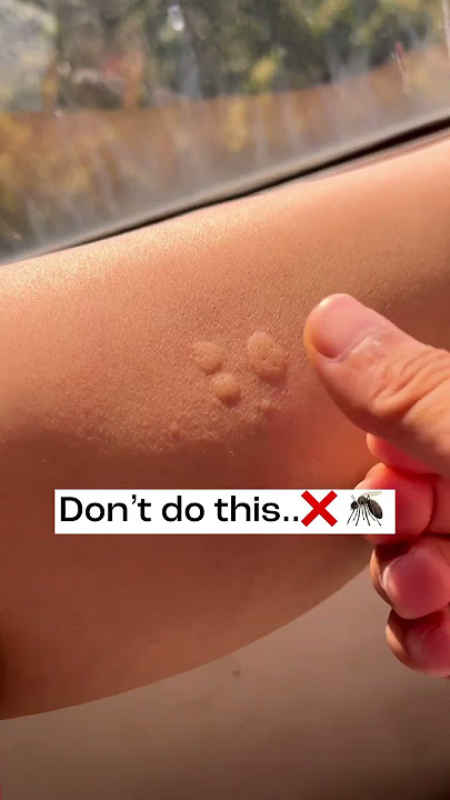 Mosquito bite 5 minutes solution 😍 🦟  no more itchiness or black spots