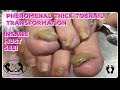 👣 How to Pedicure Cut and Shape Thick Toenails with Nail Fungus 👣