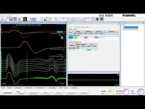 Cadwell Sierra Summit NCS+ Basics Tutorial