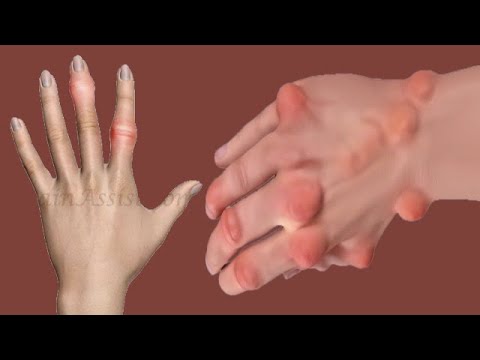 Finger Joint Pain: Causes And Symptoms - YouTube