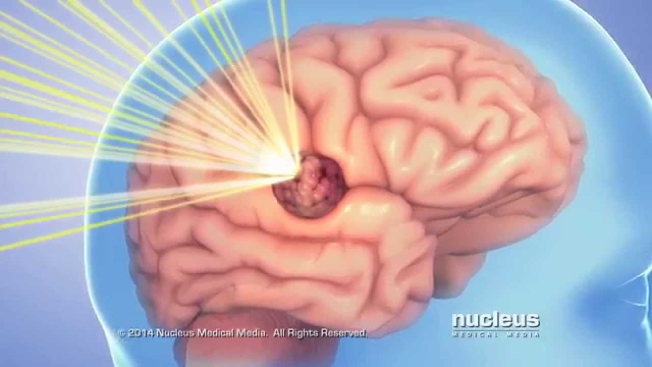 How Gamma Knife Technology Helps with Brain Tumor Treatment YouTube