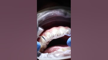 Check out this Invisalign bond up!
