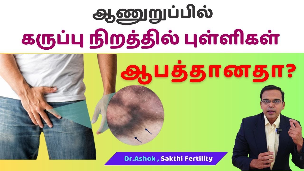 Penile melanosis: Causes, treatment | ஆணுறுப்பில் கருப்பு நிறத்தில் புள்ளிகள் ஆபத்தானதா?