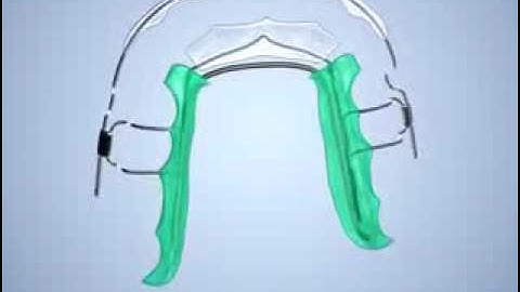 How the Inman Aligner Works