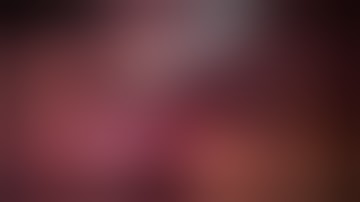 Laparoscopic cholecystectomy in a patient with gallstones and cirrhosis by Dr Hitesh Chavda