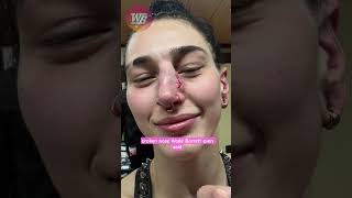 Rhea Ripley INJURED! WWE Confirms Broken Nose 😱 #wwe