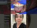 Triming Between Your Teeth To Make Room!